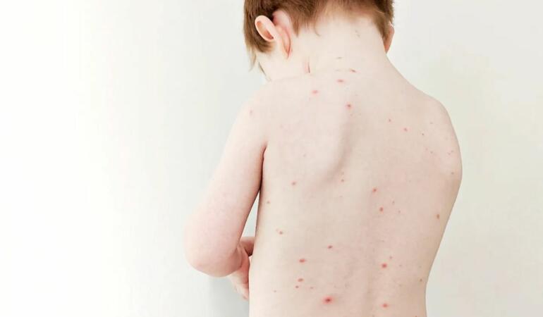 Părinții în alertă! Au explodat cazurile de varicelă. Aflați tot ce trebuie să faceți în caz de îmbolnăvire